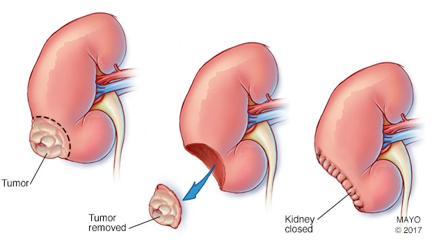 腎癌手術(shù)治療
