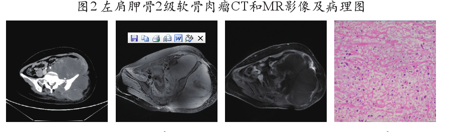 軟骨肉瘤病理