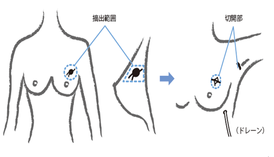 乳腺癌保乳手術(shù)