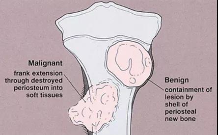 骨與軟組織腫瘤治療方法