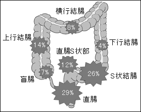大腸癌