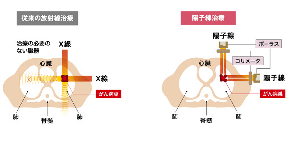 日本質(zhì)子重離子治療優(yōu)勢(shì)