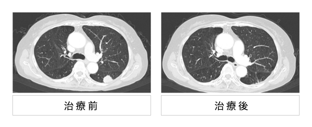 日本重離子治療肺癌媲美手術
