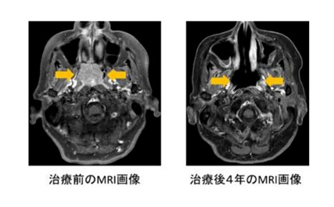 日本重離子治療頭頸部腫瘤