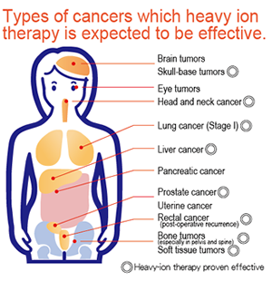 日本重離子治療腫瘤效果