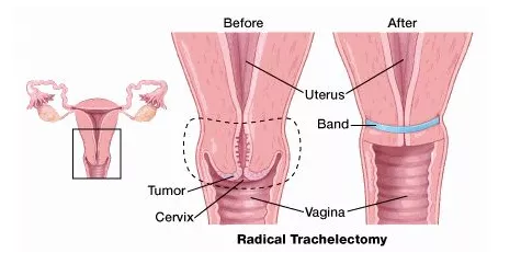 宮頸癌手術治療