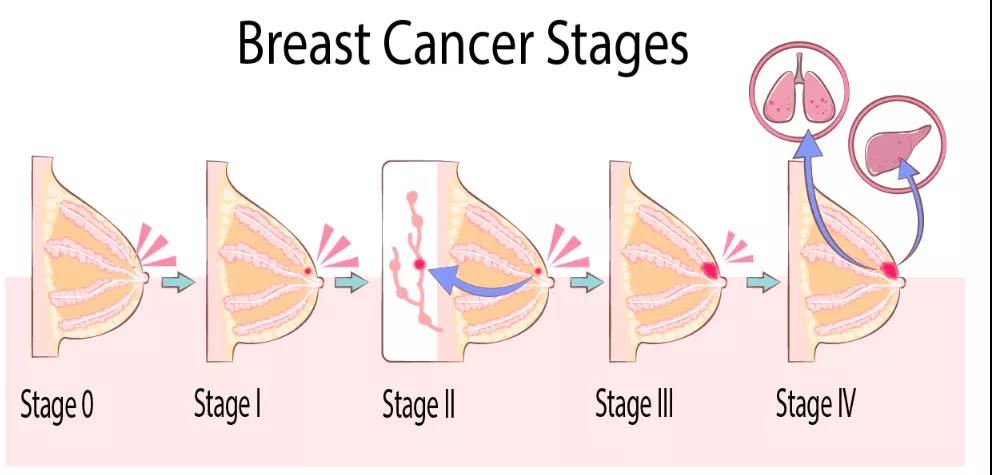 乳腺癌手術治療