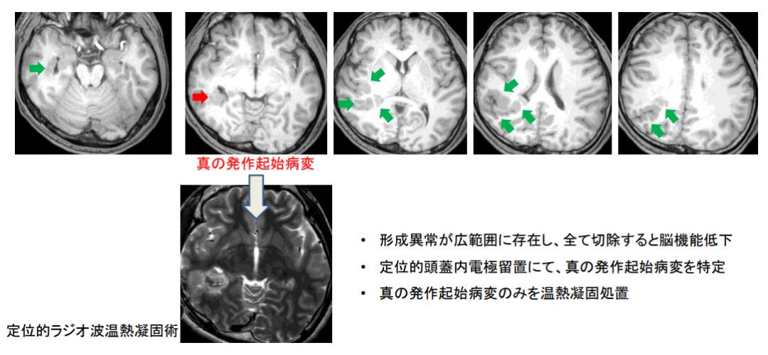 癲癇日本手術治療