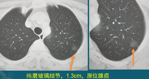 肺磨玻璃結(jié)節(jié) 肺癌