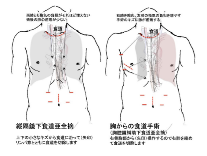 食道癌手術(shù)方式效果