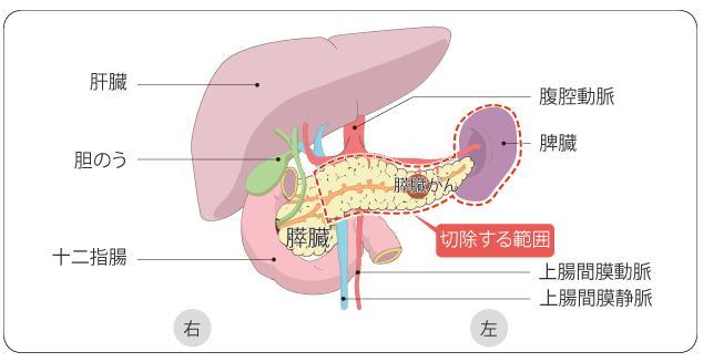 胰腺癌手術(shù)治療