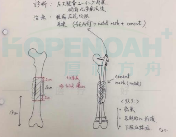 日本尤文氏肉瘤治療案例