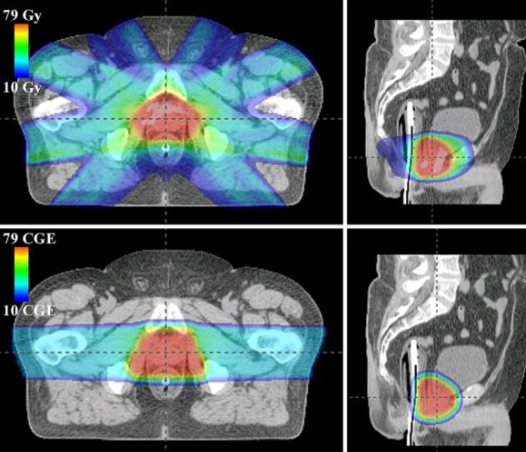 前列腺癌放療