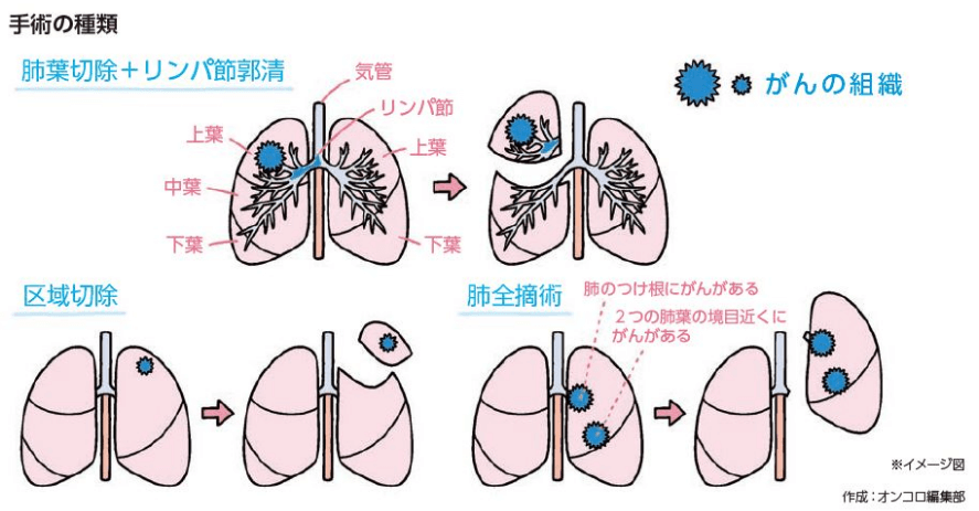 小細(xì)胞肺がんの治療－手術(shù)療法